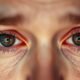 How to Get Rid of Red Eyes Fast Without Eye Drops