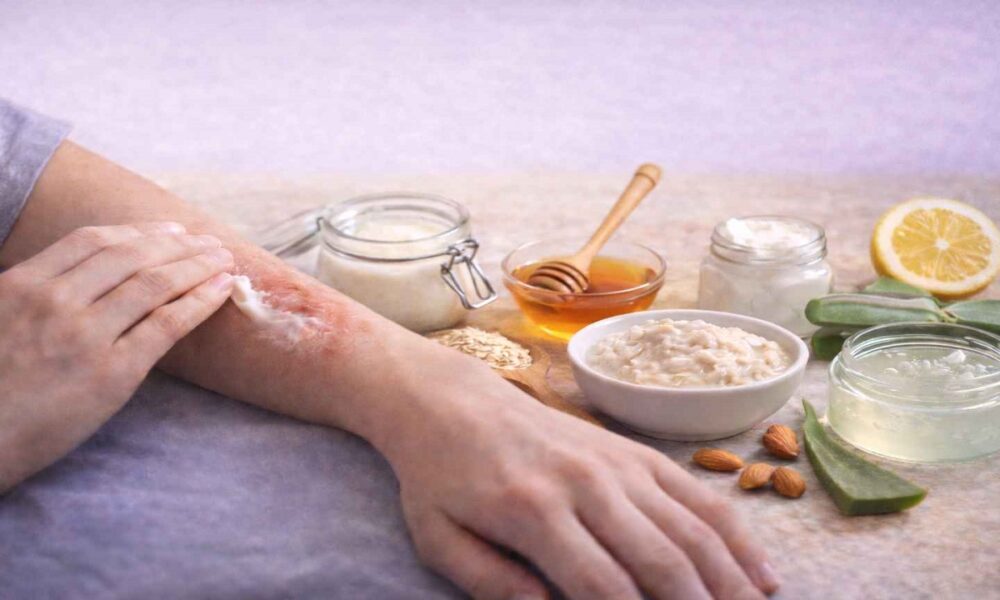 Best Homemade Remedies for Eczema: Safe, Effective Options That Soothe Skin
