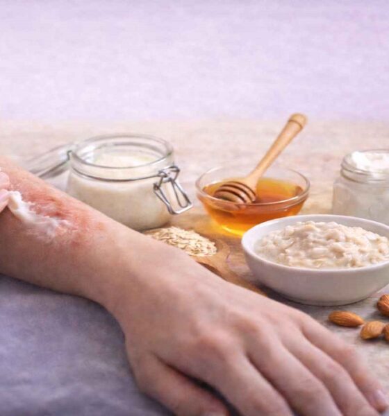 Best Homemade Remedies for Eczema: Safe, Effective Options That Soothe Skin